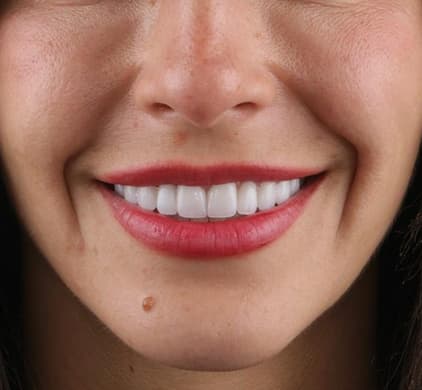 The same woman's full, white and natural-looking smile after dental implants at Iconic Smiles in Sydney