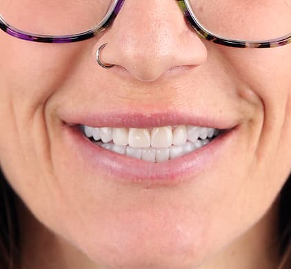 The same woman's bright, even white smile after porcelain veneers at Iconic Smiles in Sydney