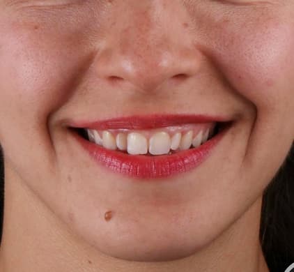 Close-up of a woman's discoloured and uneven teeth before dental implant treatment at Iconic Smiles in Sydney