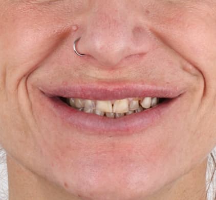 Close-up of a woman's worn, short and discoloured upper teeth before porcelain veneers at Iconic Smiles in Sydney