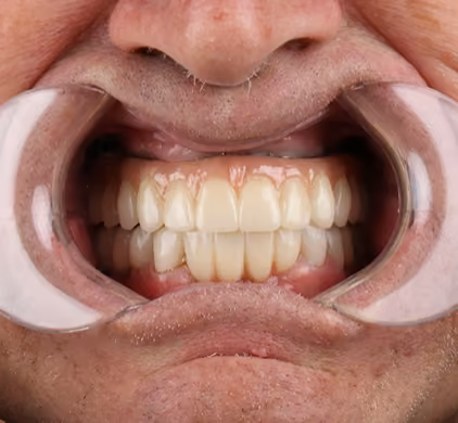 The same mouth with a full set of white, natural-looking teeth after full-arch dental implants at Iconic Smiles
