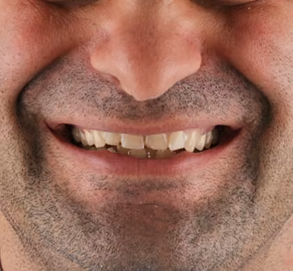 Bearded man's damaged and discoloured teeth before dental implant treatment at Iconic Smiles in Sydney