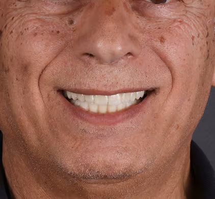The same man's complete, natural-looking white smile after dental implants at Iconic Smiles in Sydney