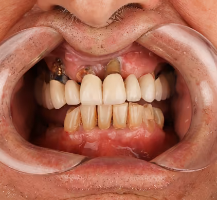 Clinical retracted-lip photo of severely decayed and damaged teeth before full-arch dental implants at Iconic Smiles, Sydney
