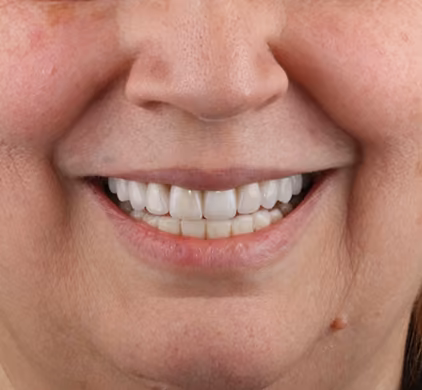 The same woman's straight, white and even smile after dental implants at Iconic Smiles in Sydney