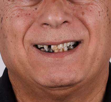Older man with missing and damaged front teeth before dental implant treatment at Iconic Smiles in Sydney