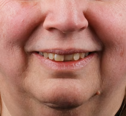 Close-up of a woman's worn and yellowed teeth before dental implant treatment at Iconic Smiles in Sydney