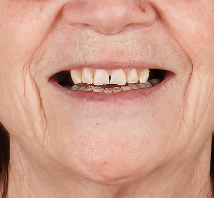 Older woman's worn, gappy and discoloured teeth before dental implant treatment at Iconic Smiles, Sydney