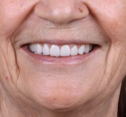 The same woman's rejuvenated, natural-looking white smile after dental implants at Iconic Smiles in Sydney