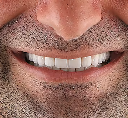 The same bearded man's full, white and natural-looking smile after dental implants at Iconic Smiles in Sydney